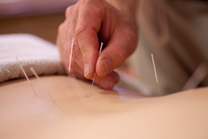 photosm_acupuncture